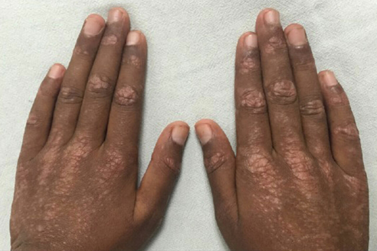 Blog Image iris clinics