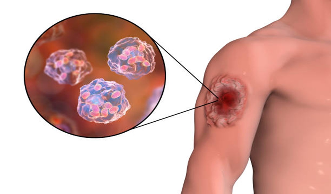 Blog Image iris clinics