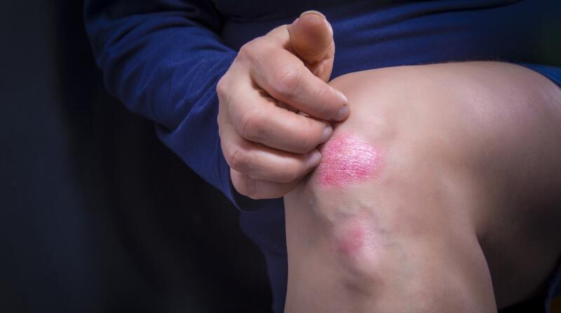 Psoriatic Arthritis - Iris Clinics