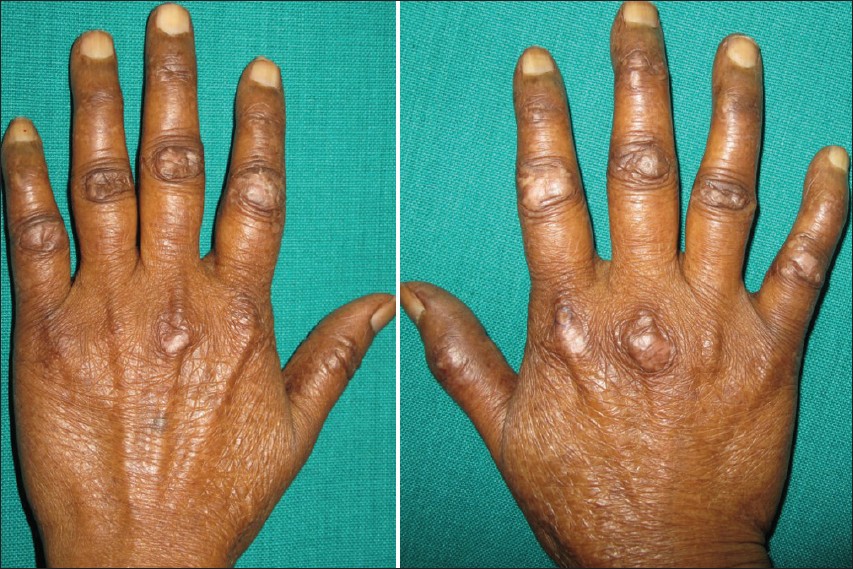 Dermatomyositis - Iris Clinics