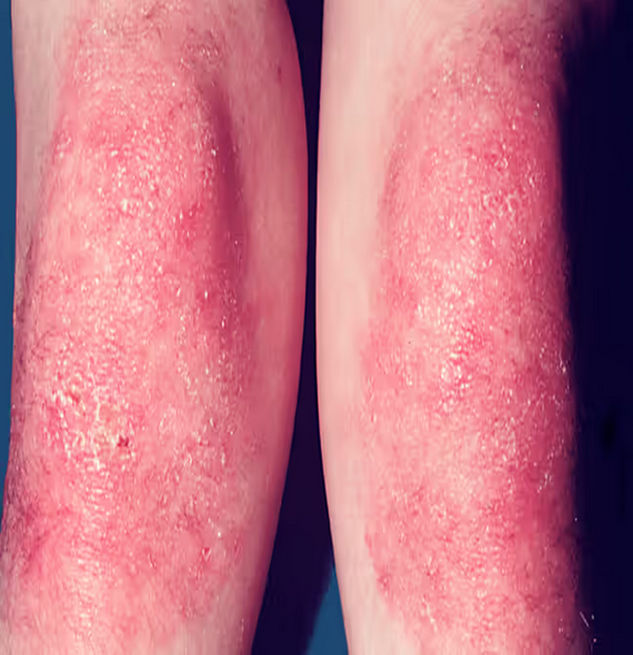 Dermatomyositis