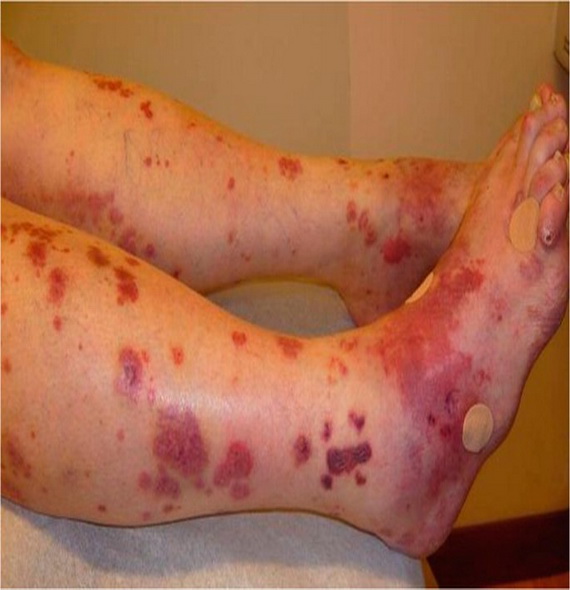 Wegener's Granulomatosis & Microscopic Polyangitis