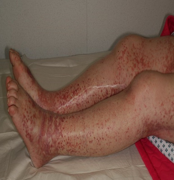 Henoch-Schonlein Purpura