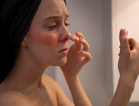 Systemic Lupus Erythematosus