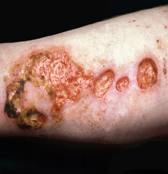 Polyarteritis Nodosa