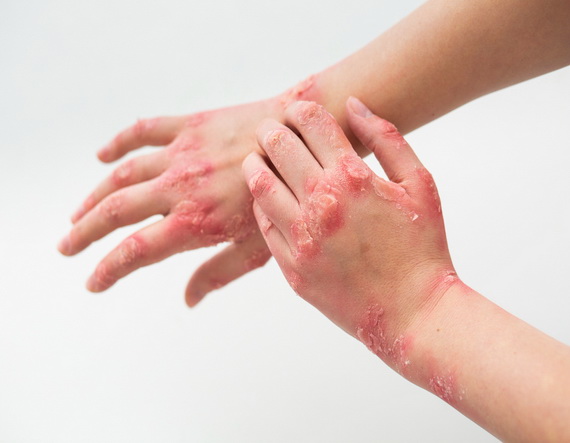 Psoriatic Arthritis
