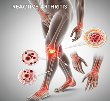 Reactive Arthritis specialist