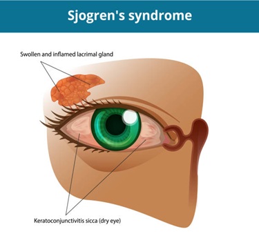 Sjogren Syndrome specialist