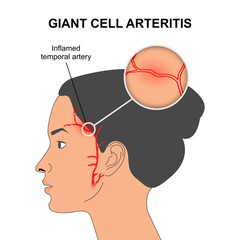 Giant Cell Arteritis & Polymyalgia Rheumatica treatment in trivandrum
