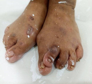 Wegener's Granulomatosis & Microscopic Polyangiitis specialist