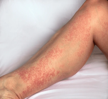 Polyarteritis Nodosa treatment in trivandrum