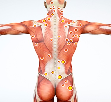 Myofascial Pain Syndromes treatment in trivandrum
