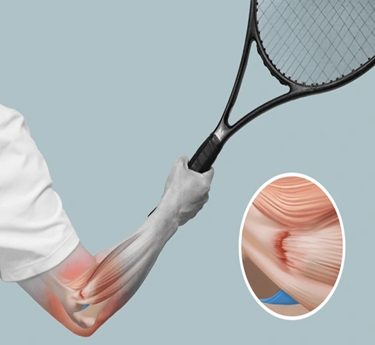 Lateral Epicondylitis (Tennis Elbow) specialist