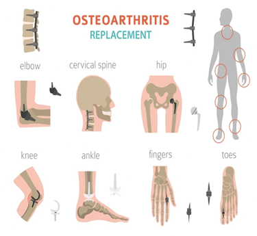 Osteoarthritis treatment in trivandrum