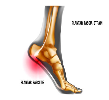 Plantar Fasciitis treatment in trivandrum