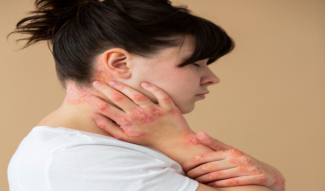 Dermatomyositis disease Image