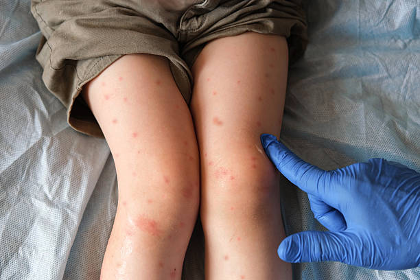 Juvenile Dermatomyositis