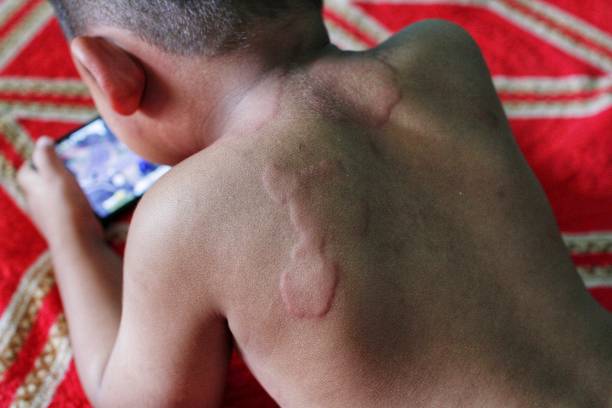 Juvenile Scleroderma