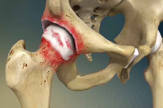 Degenerative Joint Diseases