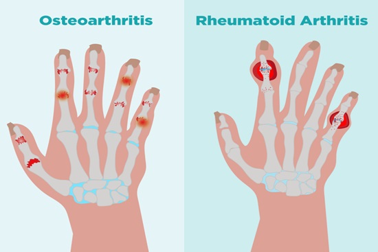 Foods that may help with arthritis