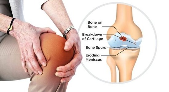 Degenerative Joint Diseases