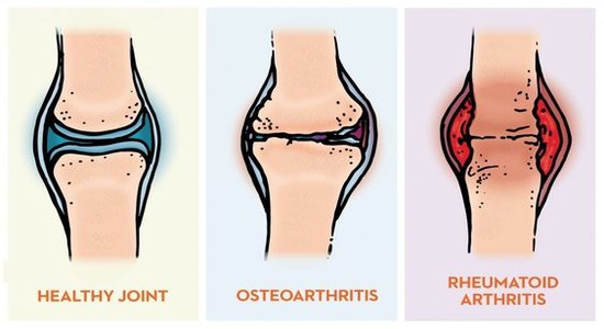 Difference Between Osteoarthritis and Rheumatoid Arthritis?