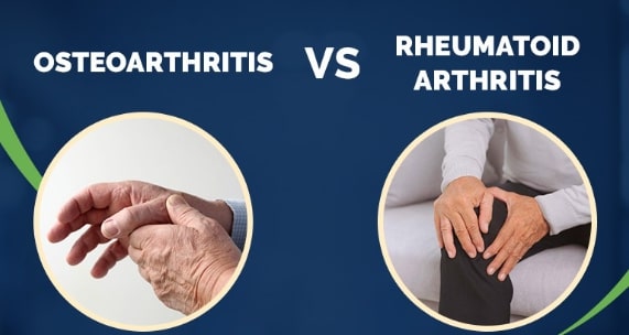 Comparison between Osteoarthritis and Rheumatoid Arthritis