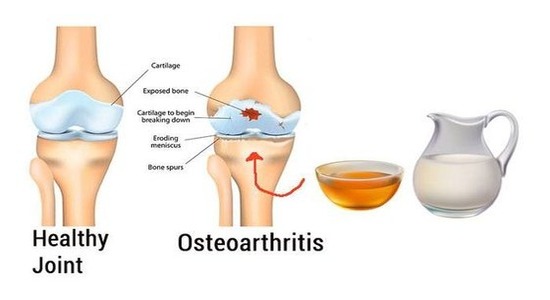 Osteoarthritis Treatment