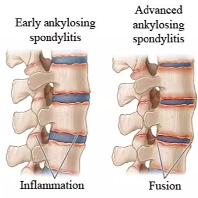 Ankylosing Spondylitis