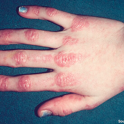 Dermatomyositis