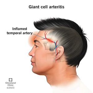 Giant Cell Arteritis & Polymyalgia Rheumatica