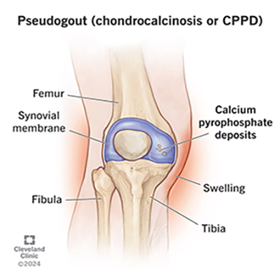 Gout and CPPD Arthropathy