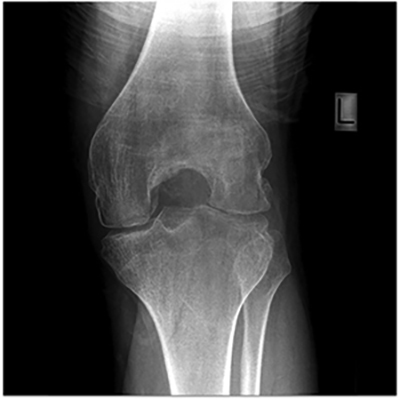 Haemophilic arthropathy