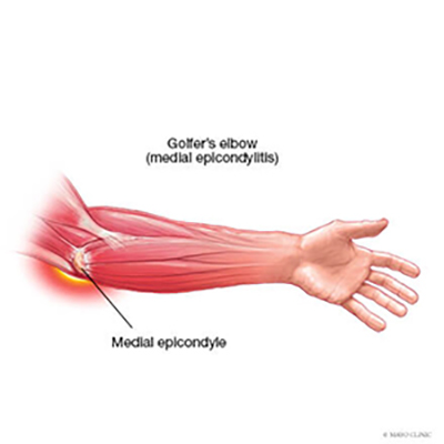 Medial epicondylitis (Golfers elbow)