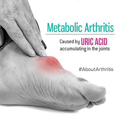 metabolic-arthropathie