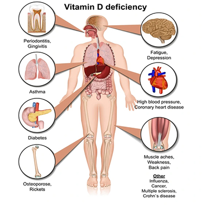 Osteoarthritis