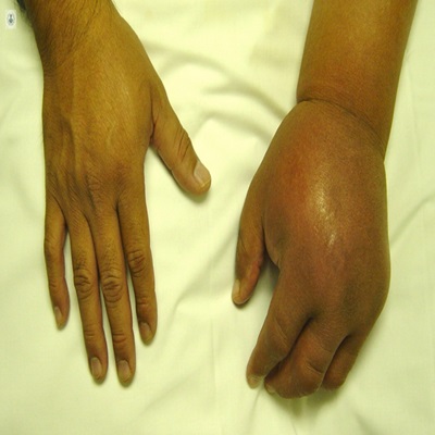 Reactive Arthritis