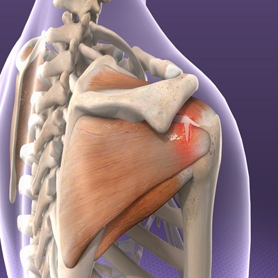 Rotator Cuff Tendinitis