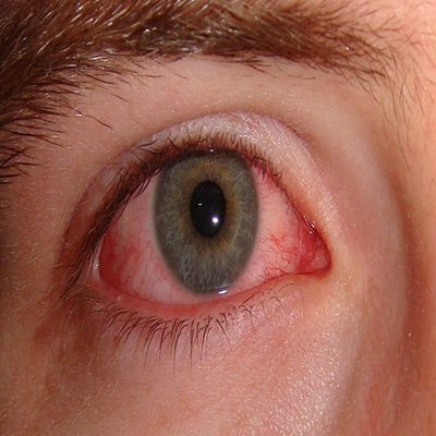 Sjogren Syndrome